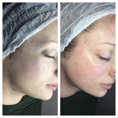 After Dermaplane Facial