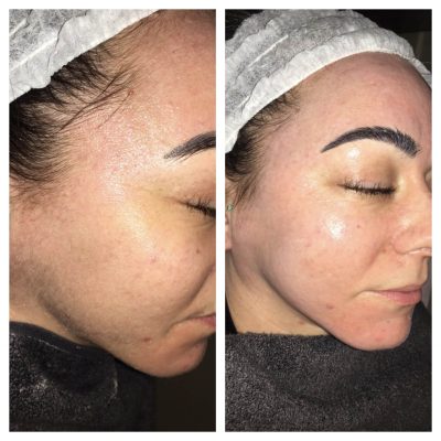 Dermaplane skin rejuvenation