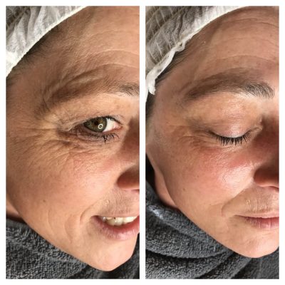 Dermaplane facial treatment results