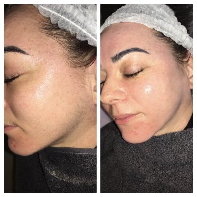 Dermaplane facial results