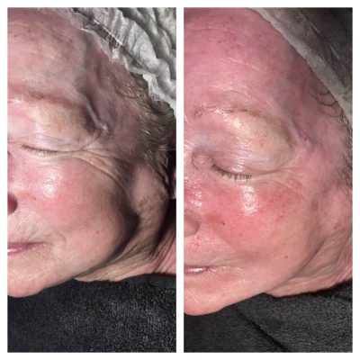 Mesotherapy before and after treatment