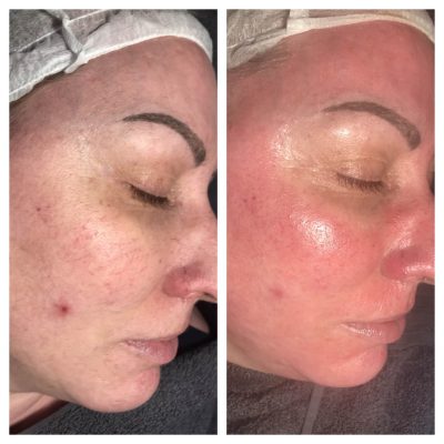 Million Dollar Facial after treatment