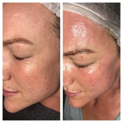 Million Dollar Facial for skin