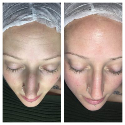 Dermaplane skin rejuvenation